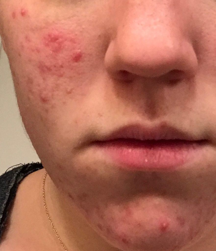 Patient's cheek before acne treatment at Acne Center of Michigan