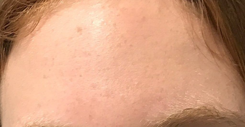 teenage acne forehead after