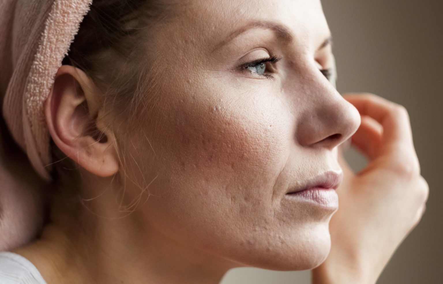 woman treated for adult female acne