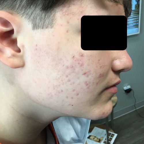 Patient's face clear after acne treatment