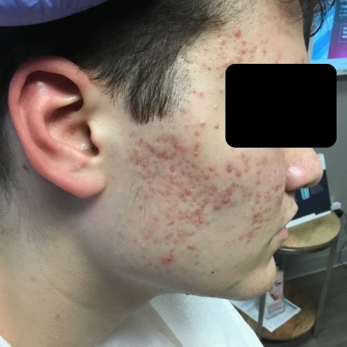 Patient's face with acne before treatment