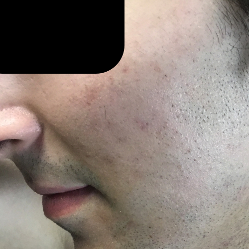 Clear skin after acne treatment