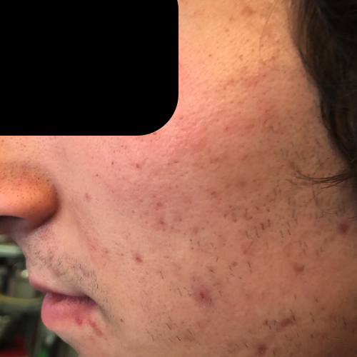 Inflammatory acne before treatment
