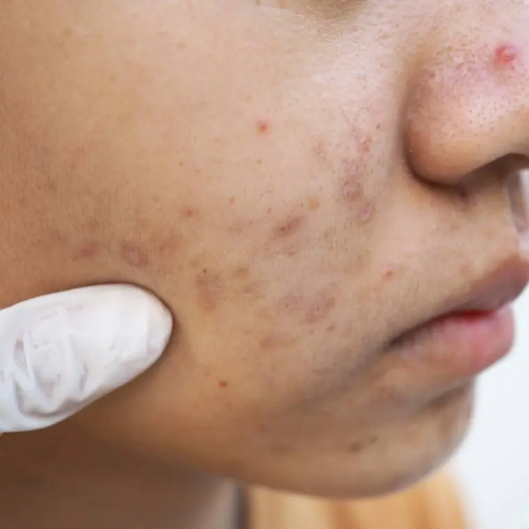 A dietary supplement can improve Acne Excoriée (skin picking in acne)