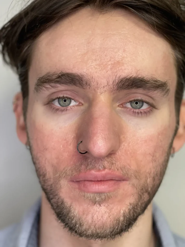 Patient after acne scar treatment