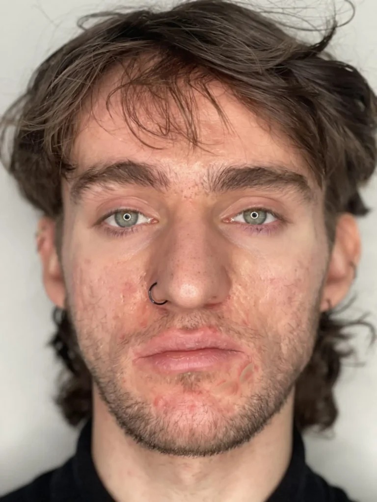 Patient before acne scar treatment