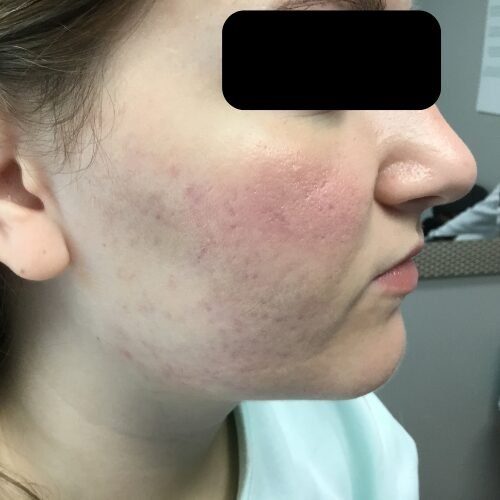 Clear skin after acne treatment at Acne Center of Michigan