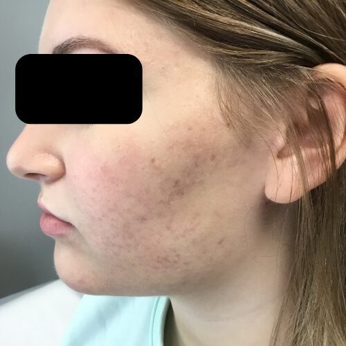 Patient's clear skin after acne treatment