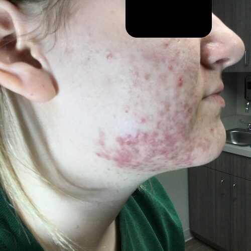 Facial acne before treatment at Acne Center of Michigan