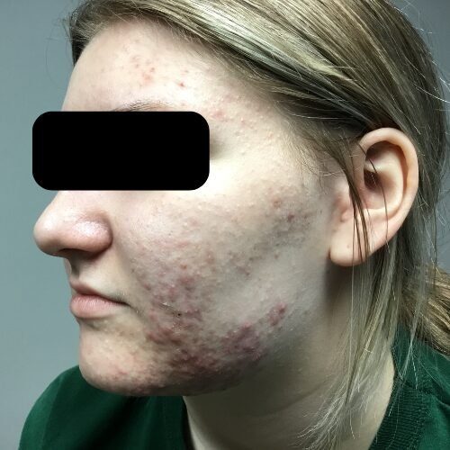Patient's face with acne before treatment
