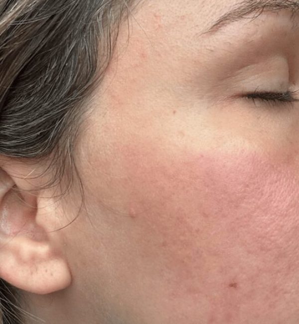 2 weeks post op: persistent erythema with visible improvement in the acne scars.