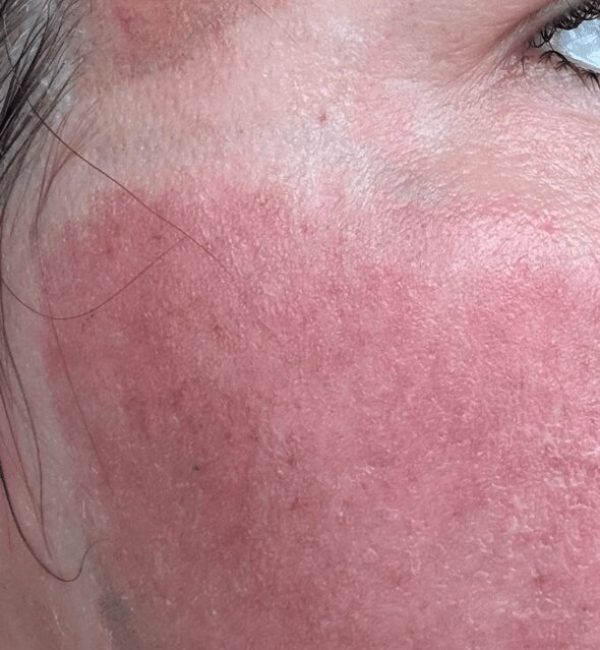 Second day post op: redness, swelling, and oozing.