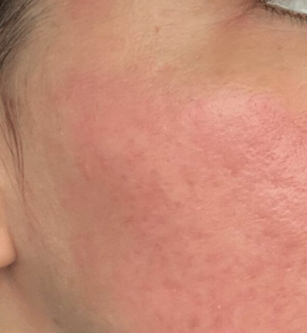 One week post op: loss of the grid pattern with persistent erythema and continued peeling.
