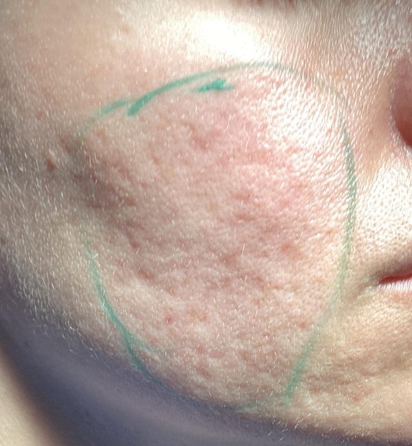 Preoperative: a large number of box car, rolling, and ice pick scars.